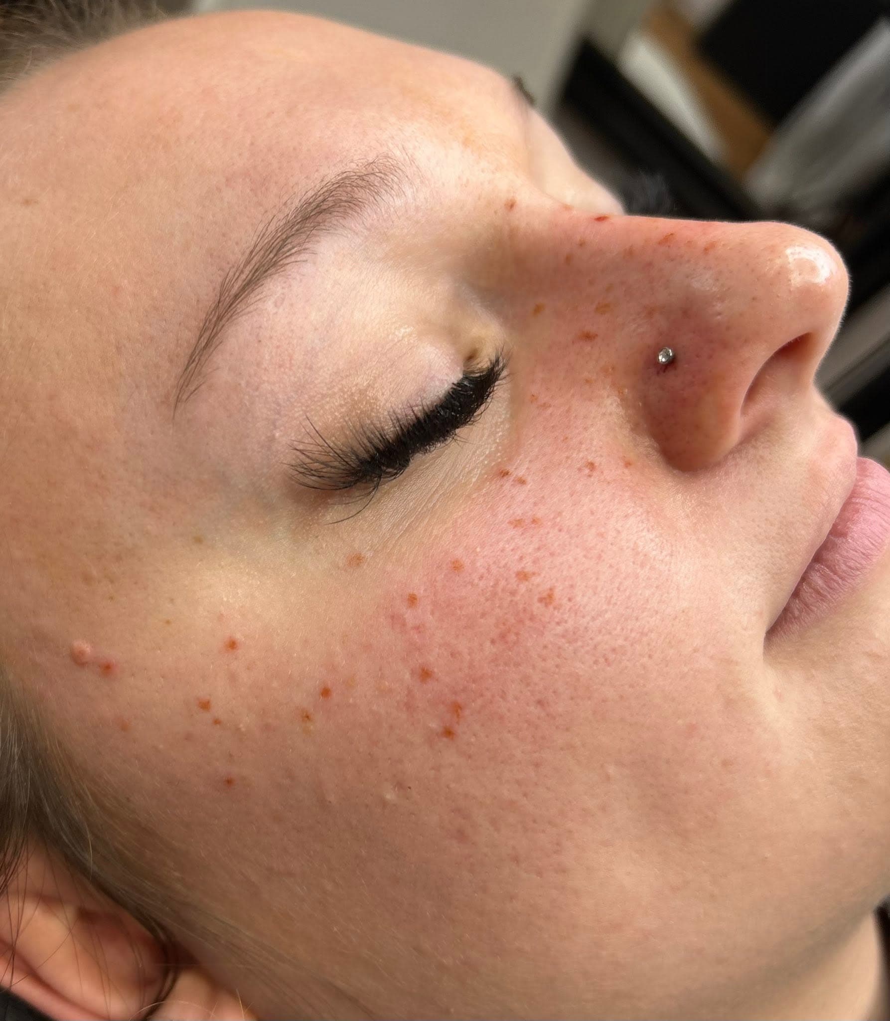 Taches de rousseur semi-permanentes sur les joues et le nez